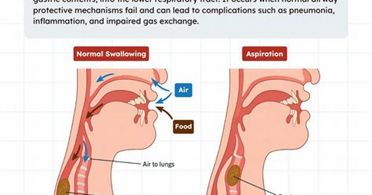 How Can a Seizure Prevent Aspiration?