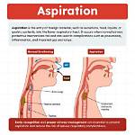 How Can a Seizure Prevent Aspiration?