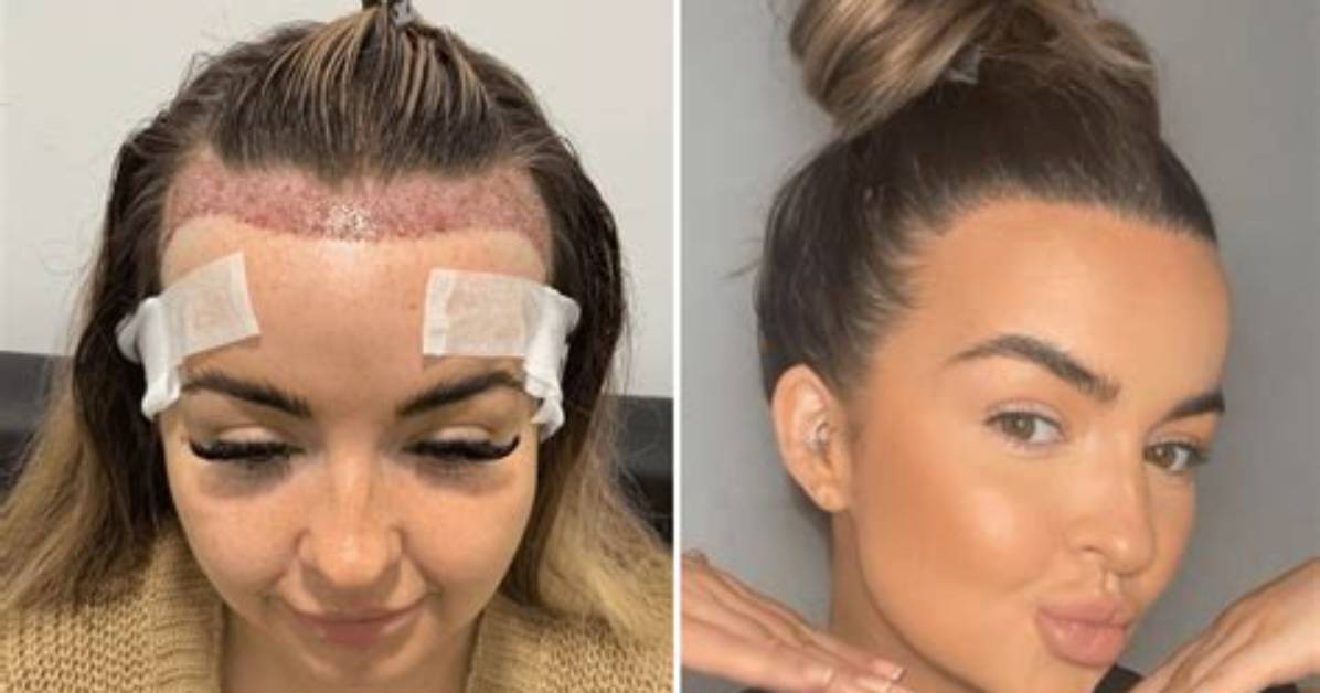 How Can I Change My Hairline?