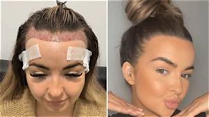 How Can I Change My Hairline?
