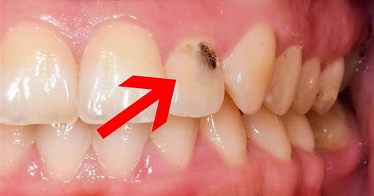How Can I Cover a Black Tooth?