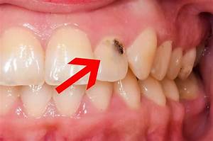 How Can I Cover a Black Tooth?