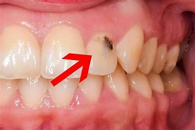 How Can I Cover a Black Tooth?