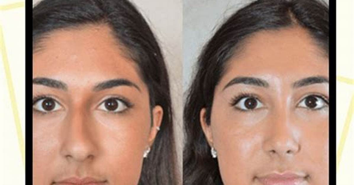 How Can I Fix My Broad Nose?