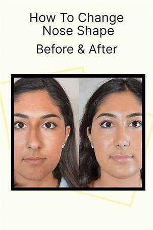 How Can I Fix My Broad Nose?