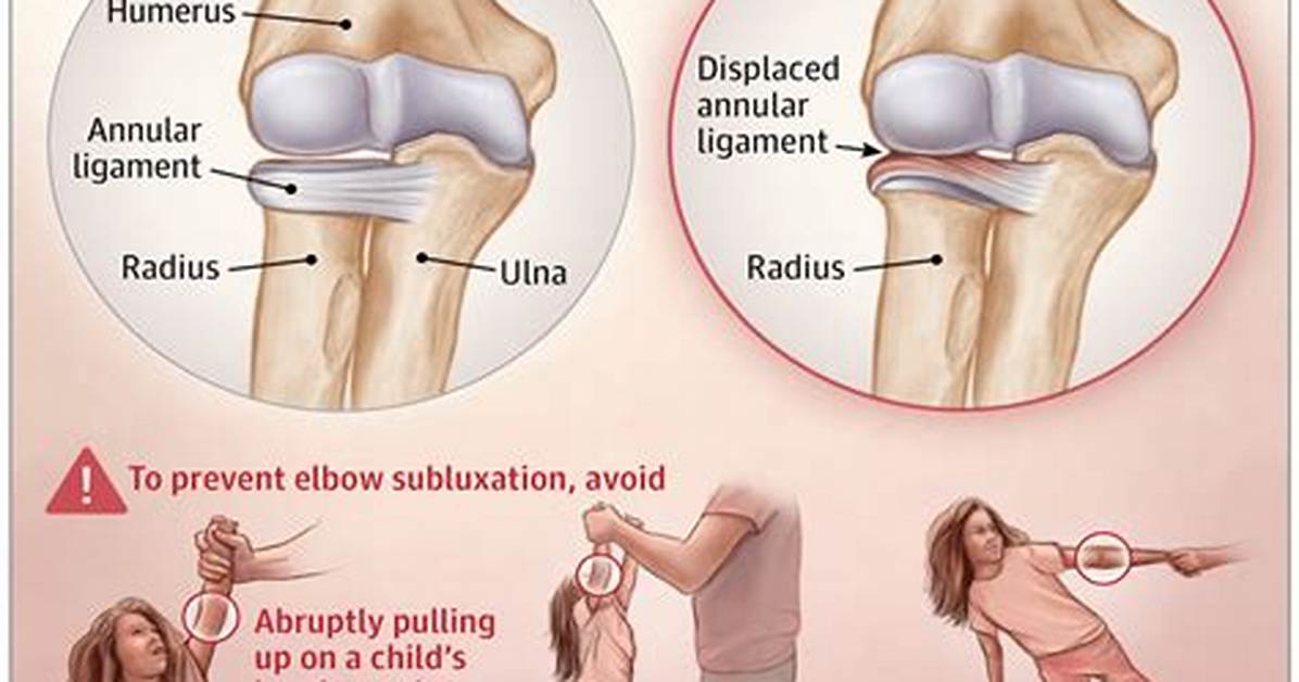 How Can I Fix My Nursemaid Elbow at Home?