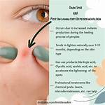 How Dermatologist Remove Dark Spots?