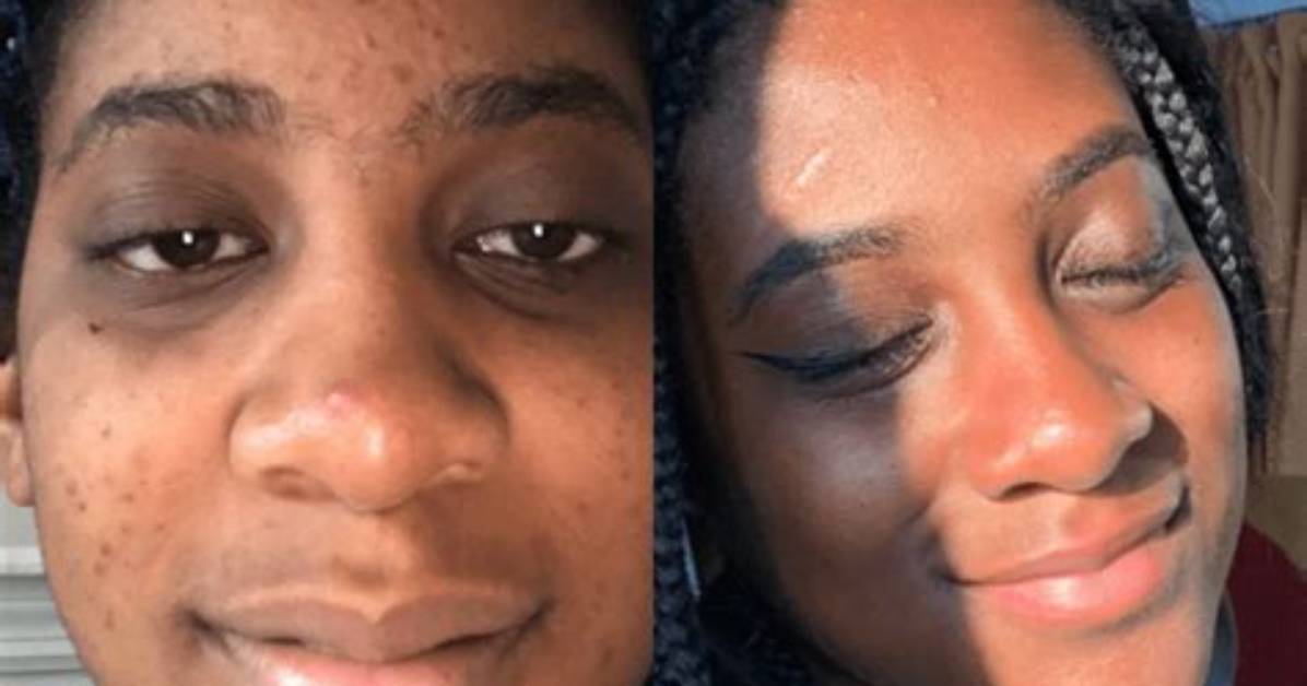 How Do Celebrities Get Clear Skin?