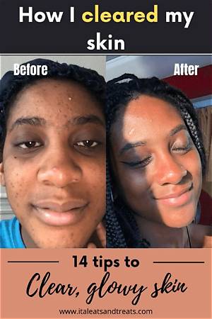 How Do Celebrities Get Clear Skin?