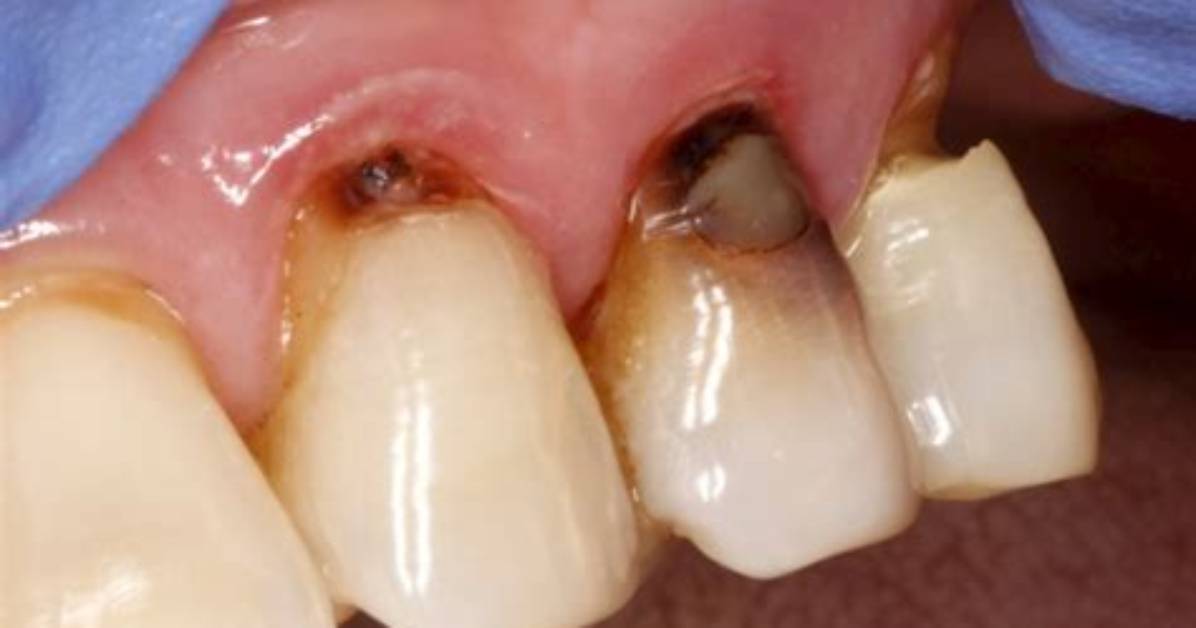 How Do Dentists Fix an Exposed Root?