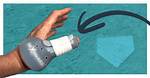 How Do You Cure Catcher's Thumb?