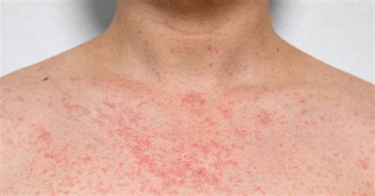 How Do You Dry out a Rash Fast?