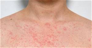 How Do You Dry out a Rash Fast?