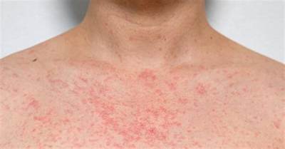 How Do You Dry out a Rash Fast?