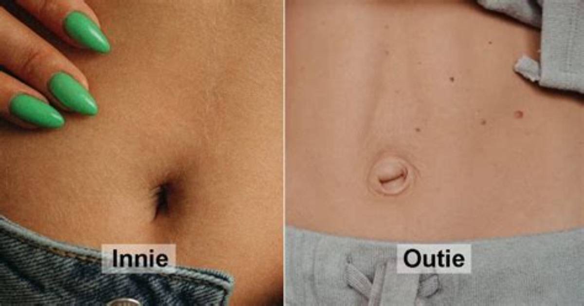 How Do You Get Outie Belly Button