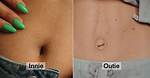 How Do You Get Outie Belly Button