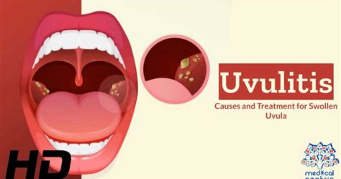How Do You Get Rid of Uvulitis?