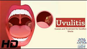 How Do You Get Rid of Uvulitis?