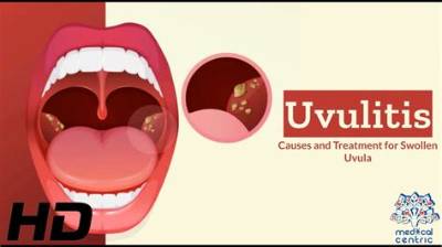How Do You Get Rid of Uvulitis?