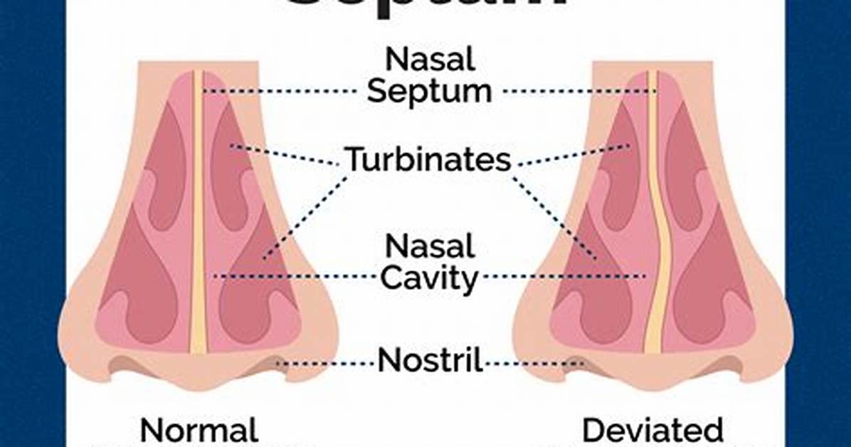 How Do You Know If Your Septum Is Perforated?