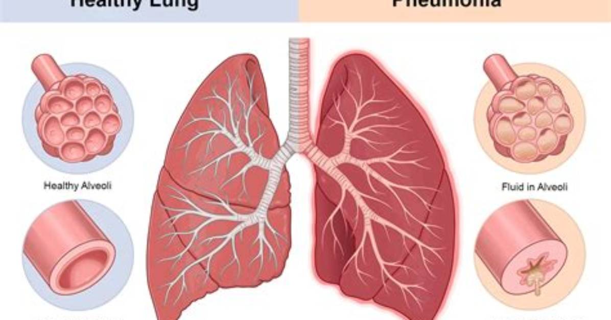 How Do You Know You Have Pneumonia Covid?