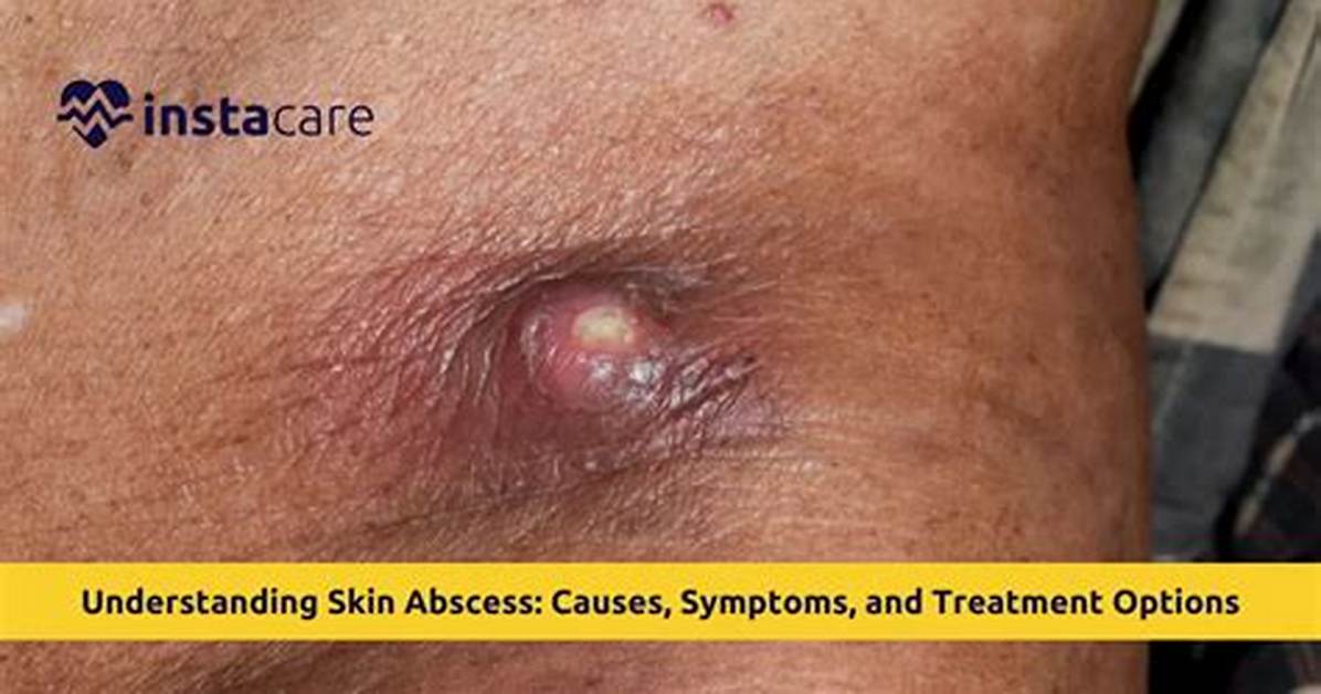 How Do You Stop Abscess Pain?