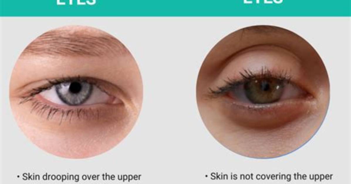 How Do You Stop Hooded Eyes?