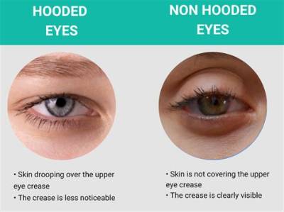 How Do You Stop Hooded Eyes?