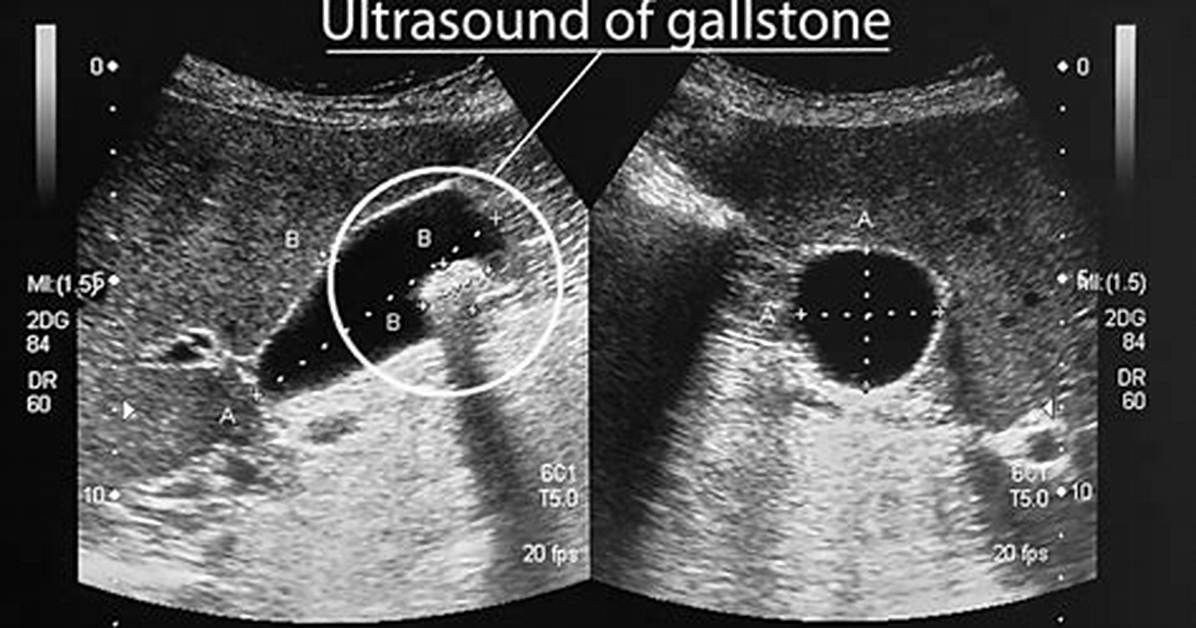 How Do You Treat a Ruptured Gallbladder?