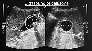 How Do You Treat a Ruptured Gallbladder?