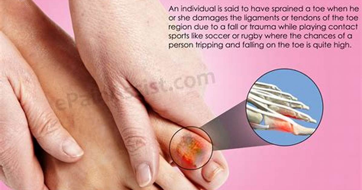 How Do You Treat a Sprained Toe at Home?