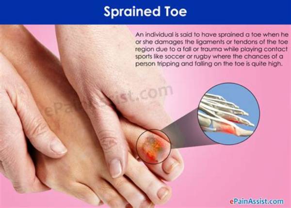 How Do You Treat a Sprained Toe at Home?