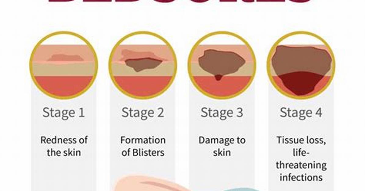 How Do You Treat Bed Sores on the Bottom?