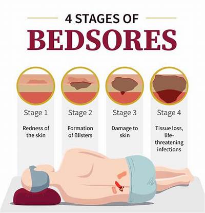 How Do You Treat Bed Sores on the Bottom?