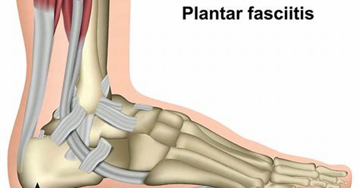 How Does a Podiatrist Treat Plantar Fasciitis?
