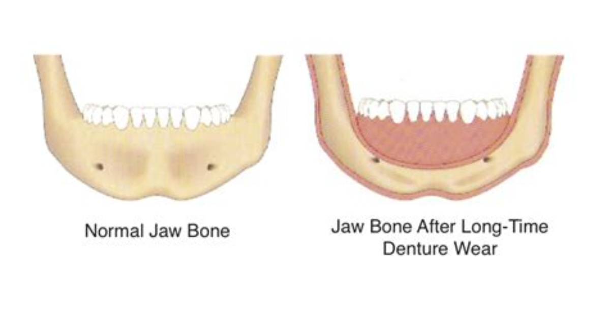 How Fast Is Bone Loss with Dentures?