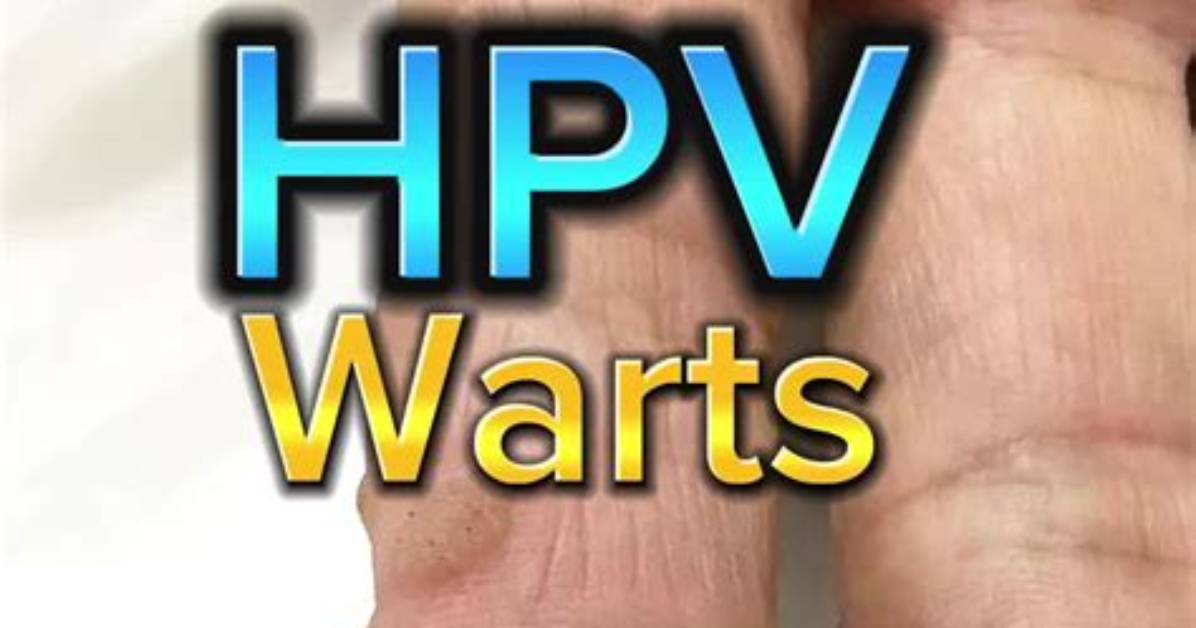 How Long After Hpv Do Warts Appear?