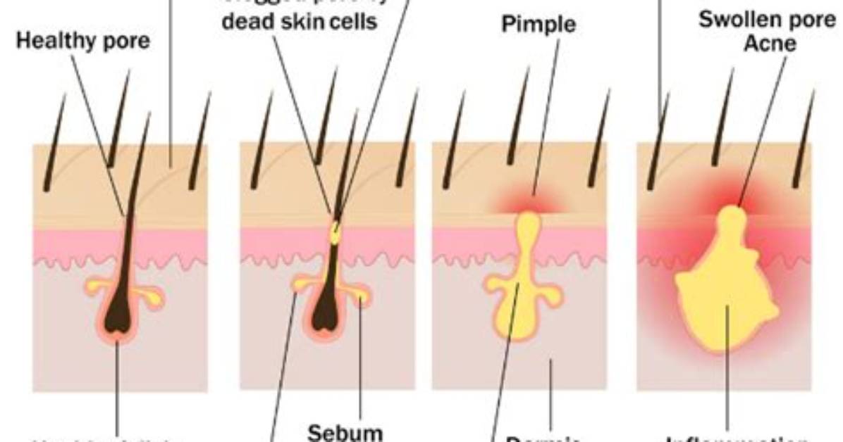 How Long Do Blind Pimples Last?