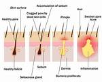 How Long Do Blind Pimples Last?