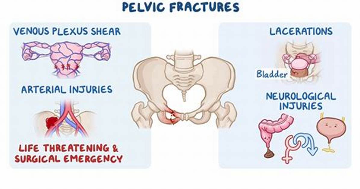 How Long Do Pelvic Fractures Take to Heal?