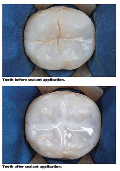How Long Does Fissure Sealant Last?