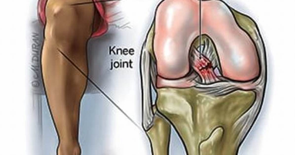 How Long Does Pain from Acl Tear Last?