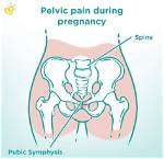 How Long Does Pain Last After Pelvic Fracture?