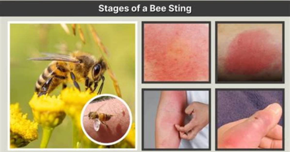 How Long Will a Bee Sting Stay Swollen?