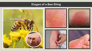 How Long Will a Bee Sting Stay Swollen?