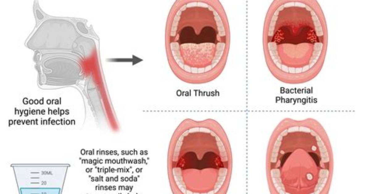 How Long Will My Throat Hurt After General Anesthesia?
