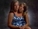 How Many Conjoined Twins Are There in the World?