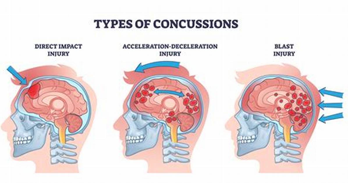 How Many G's Is a Concussion?