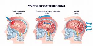 How Many G's Is a Concussion?