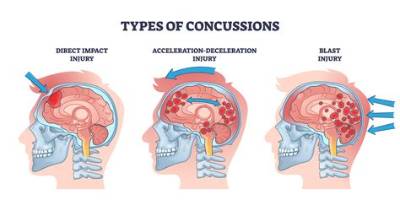 How Many G's Is a Concussion?
